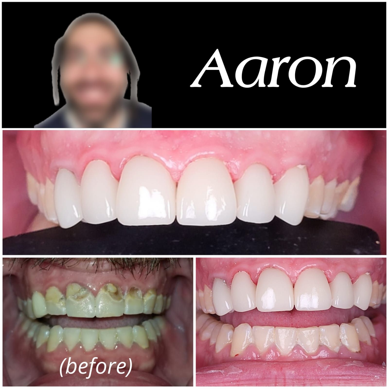 Smile transformation — Aaron